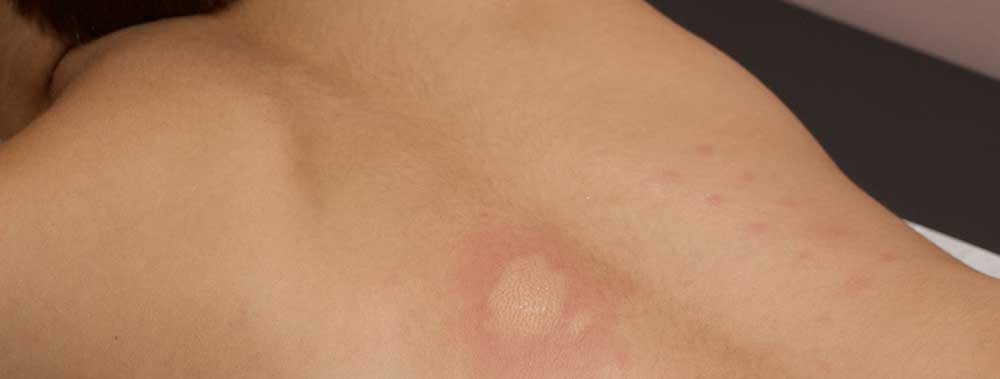 alllergy-skin-test